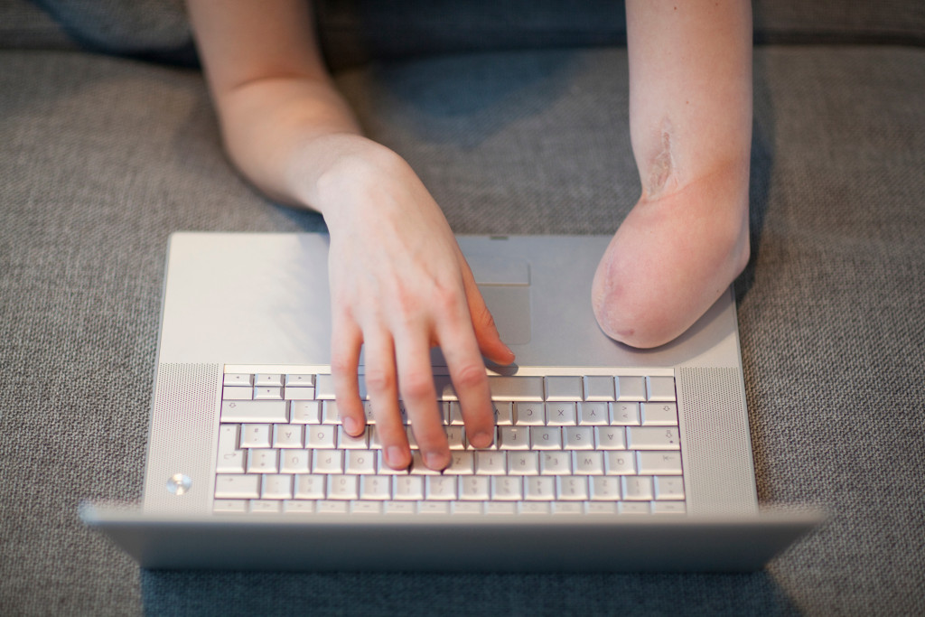 A close-up of an amputee's hand and amputated limb typing on a laptop