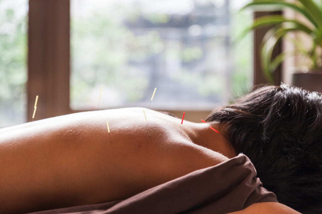 male getting acupuncture needles stuck in his back in a spa